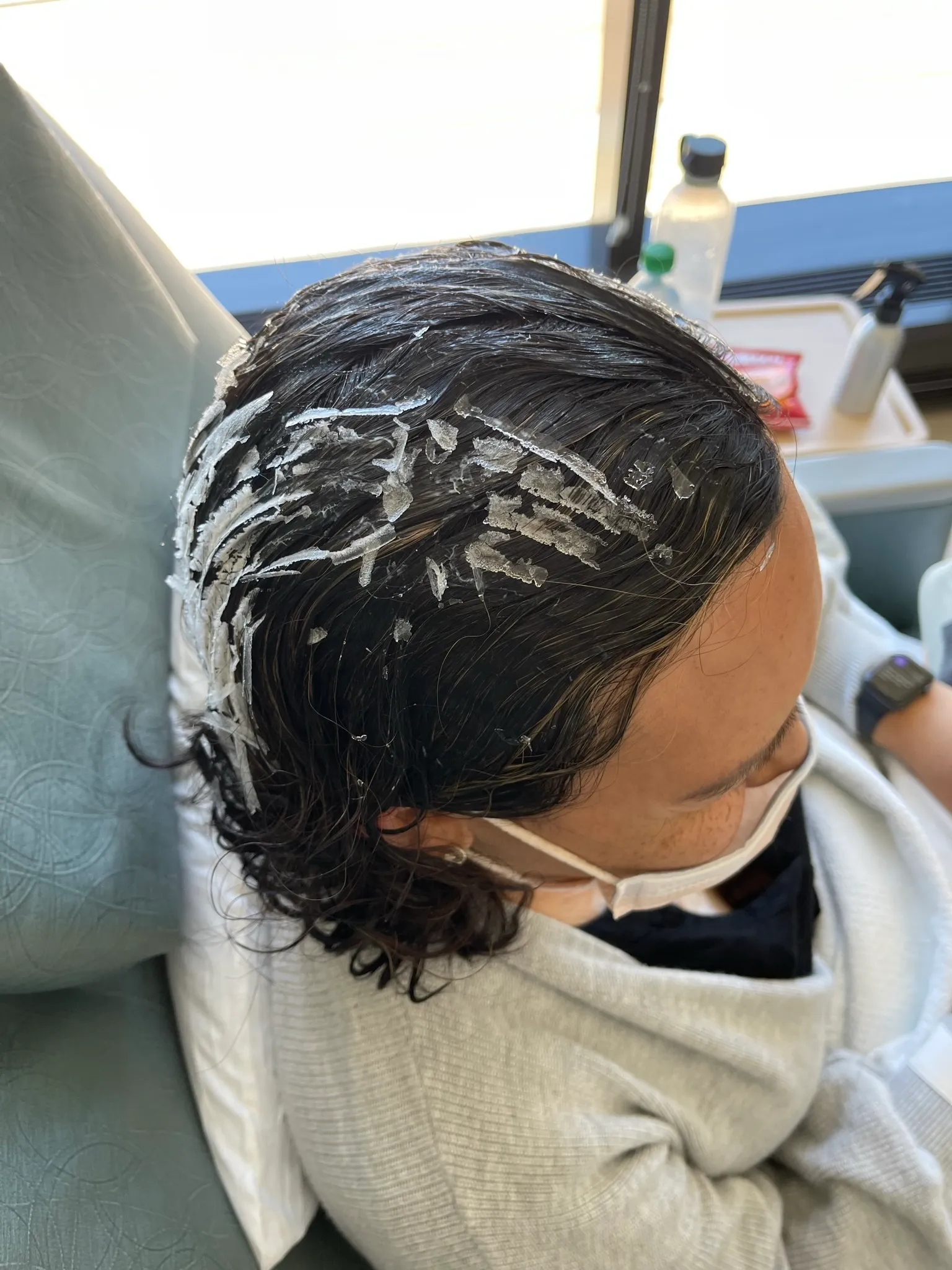 Lots of ice on my head after the cold cap is removed!